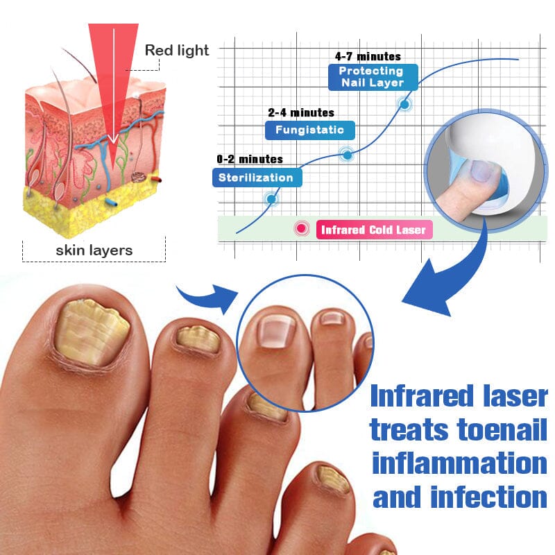 Furzero™ Nail Fungus Cleaning Laser Relief Device